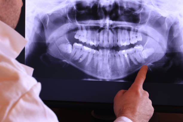 Best Emergency Wisdom Tooth Extraction in Cedaredge, CO